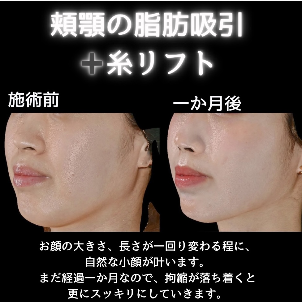 頬顎の脂肪吸引＋糸リフトの症例写真