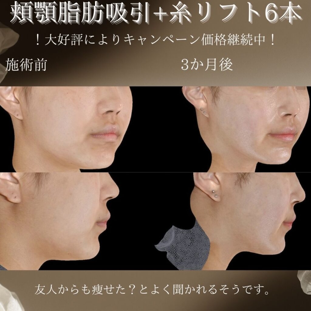 頬顎脂肪吸引＋糸リフト６本の症例写真
