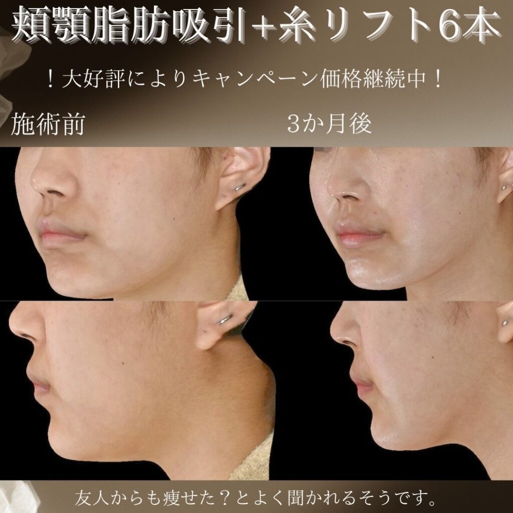 頬顎脂肪吸引＋糸リフト６本の症例写真