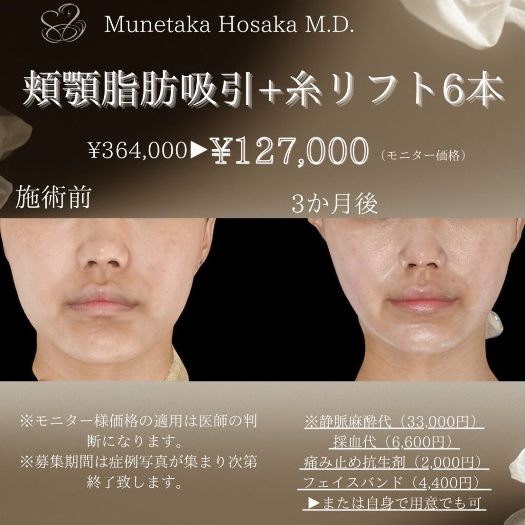 頬顎脂肪吸引＋糸リフト６本の症例写真