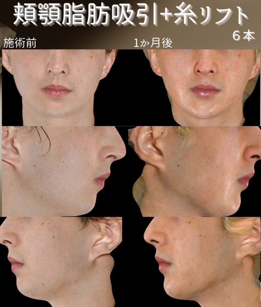 頬顎脂肪吸引＋糸リフトの症例写真