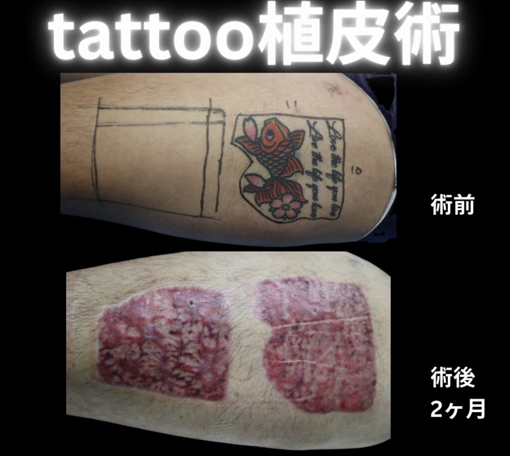 tattoo植皮術の症例写真