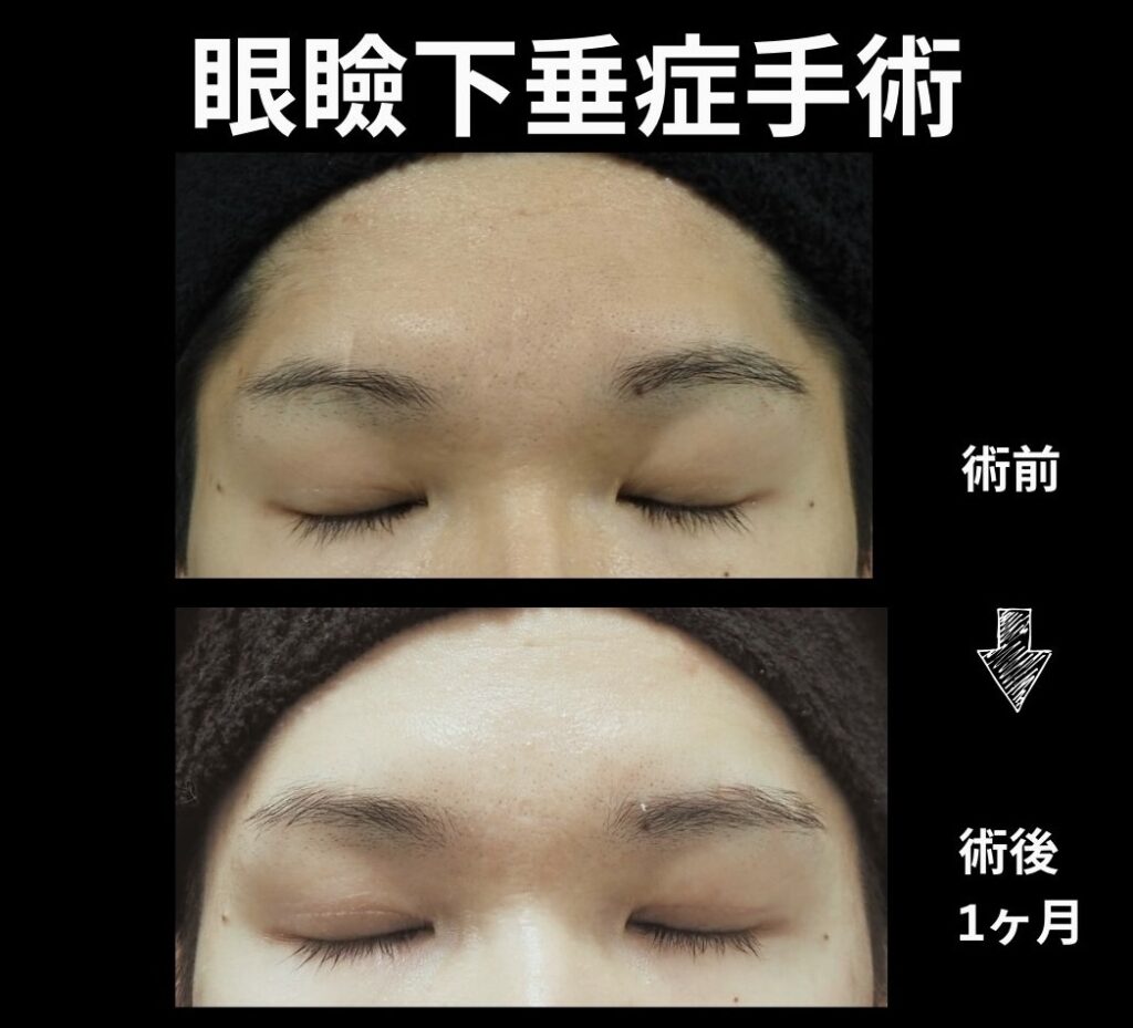 眼瞼下垂症手術(閉瞼時)