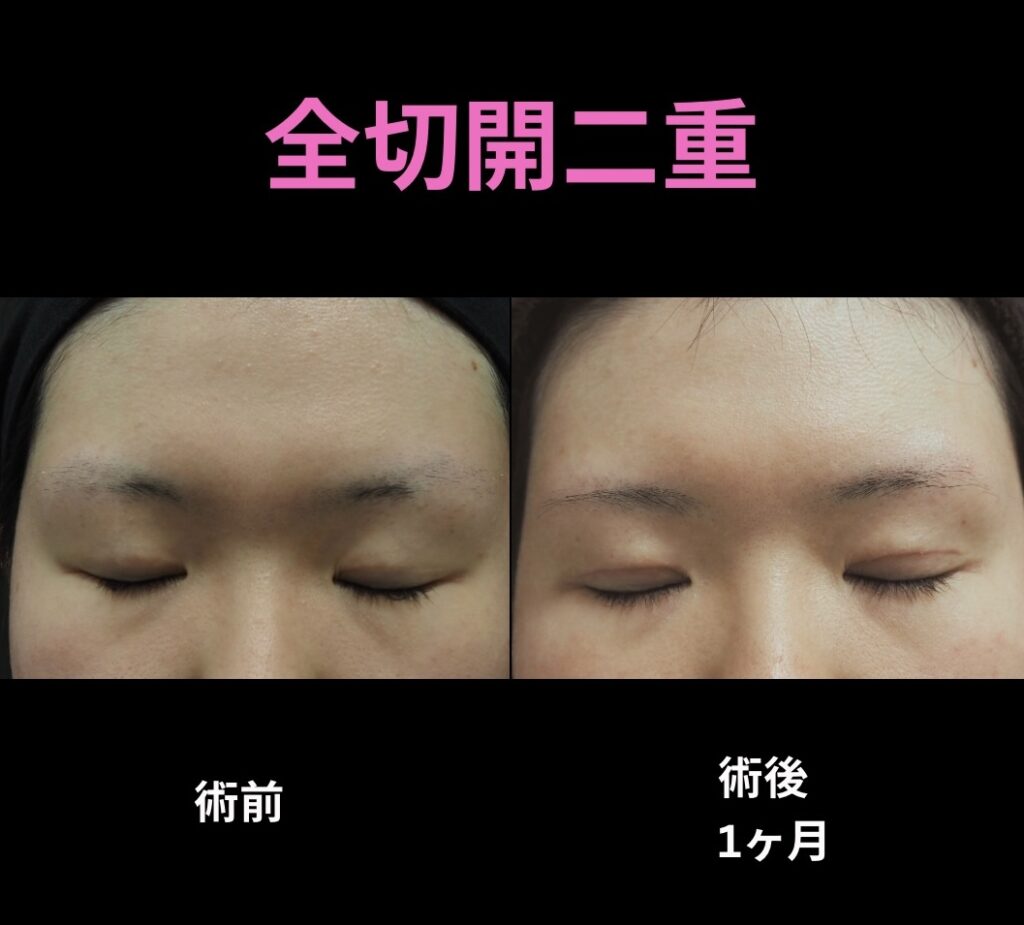 二重全切開二重術の術前後写真