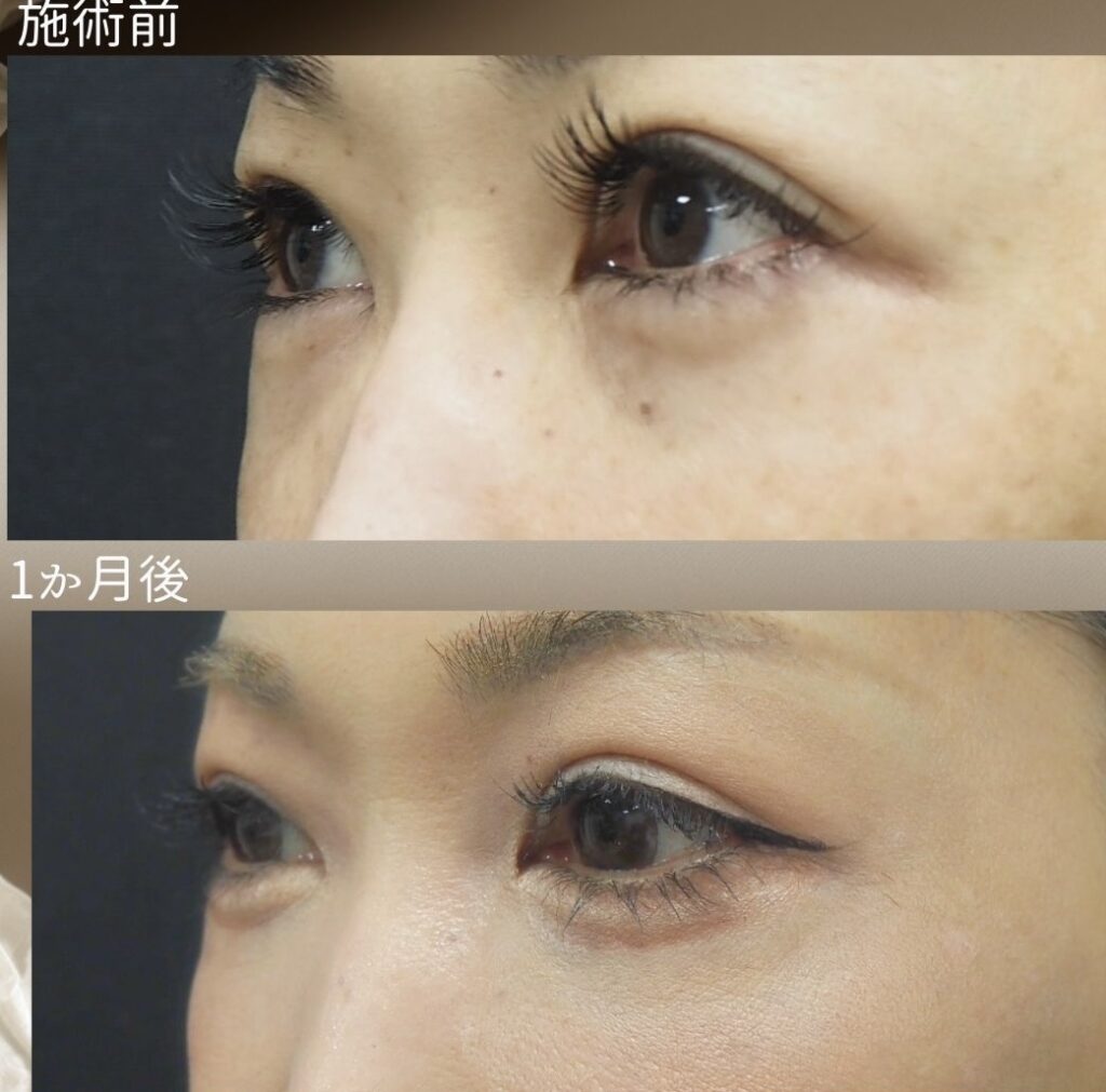 裏ハムラの症例写真　右斜視像