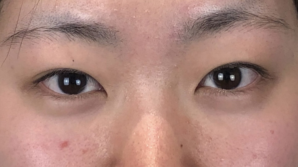 埋没法二重術、術前の画像