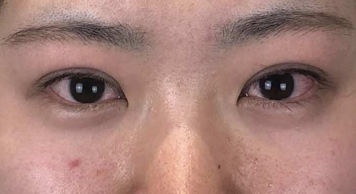 埋没法二重術、術直後の画像