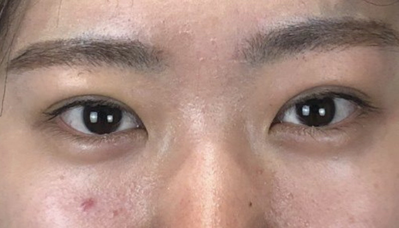 埋没法二重術、術後２日目の画像