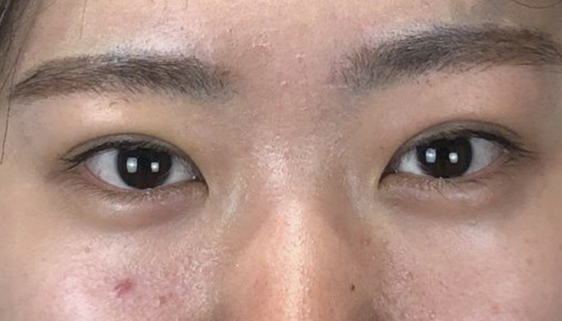 埋没法二重術、術後2日目の画像