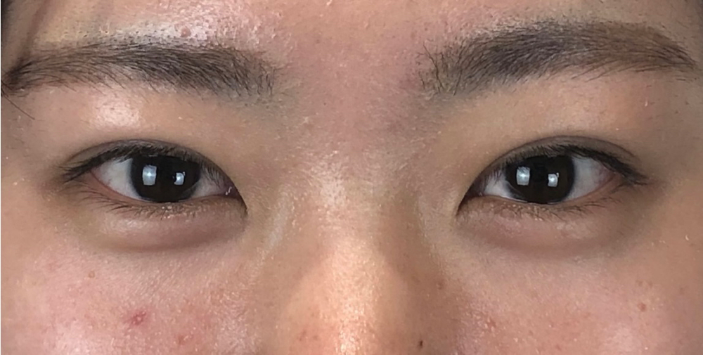 埋没法二重術、術後1週間の画像