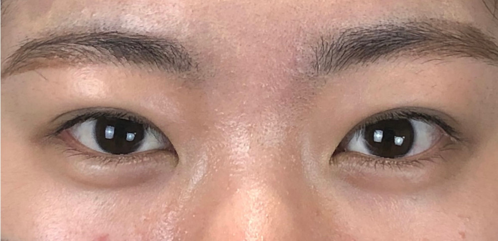 埋没法二重術、術後１ヶ月の画像