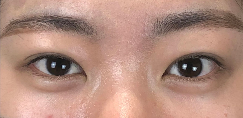 埋没法二重術、術後1ヶ月の画像