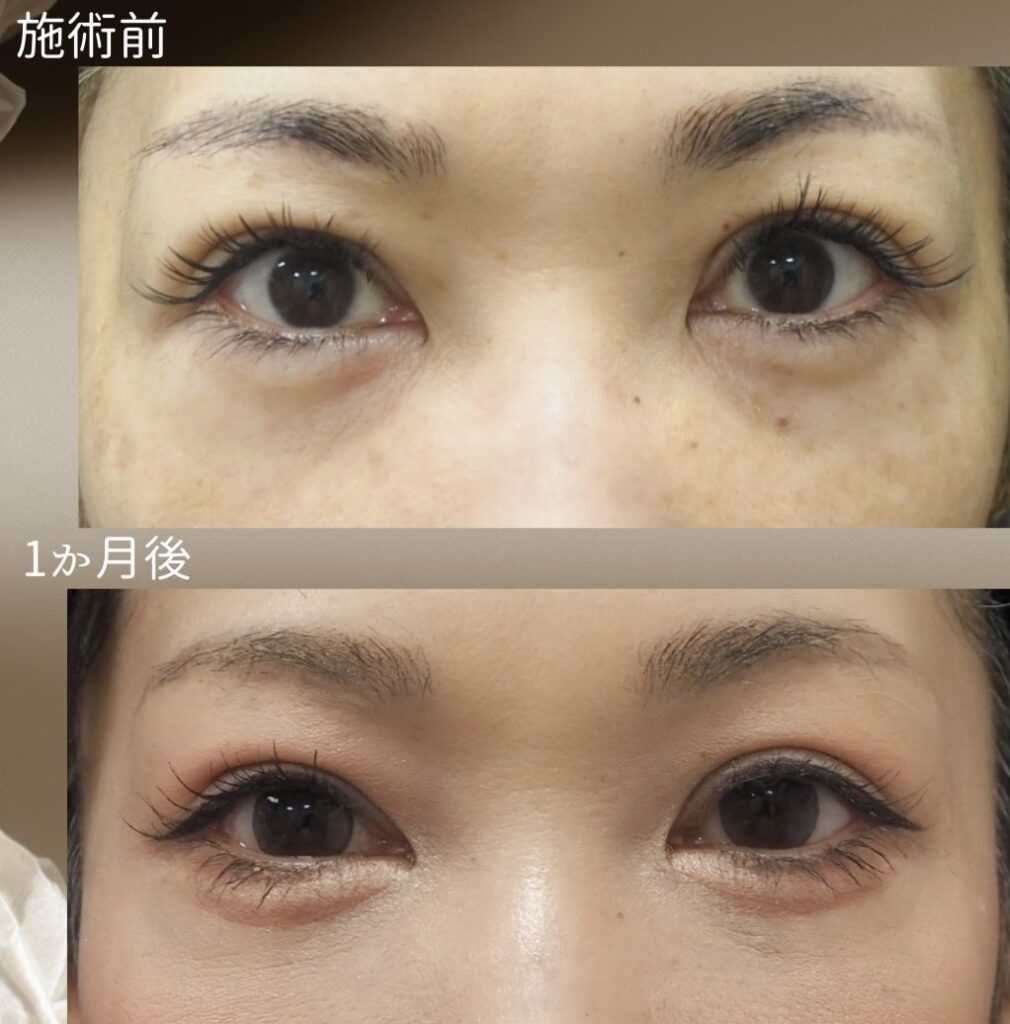 裏ハムラの症例写真　正面像