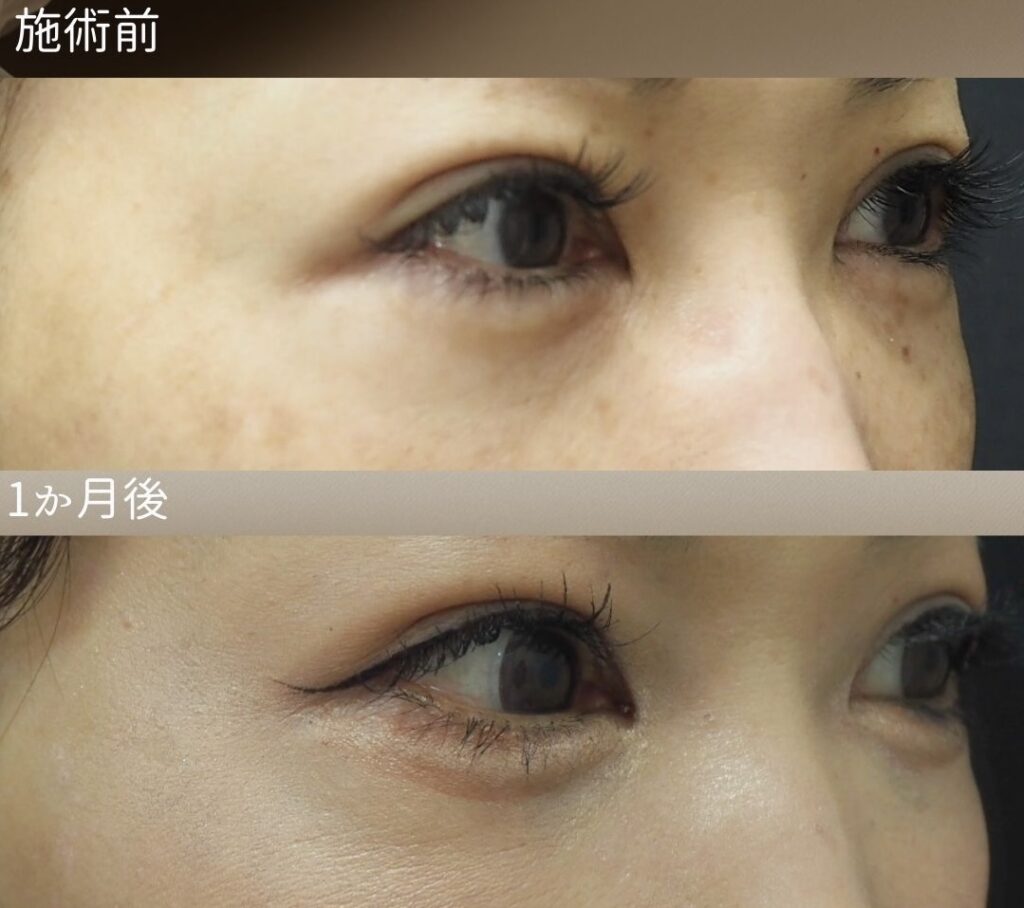 裏ハムラの症例写真　左斜視像