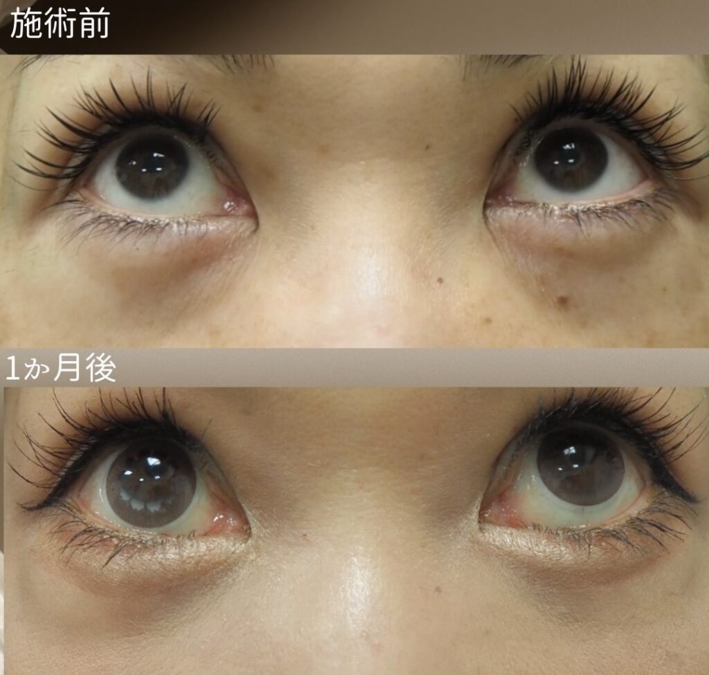 裏ハムラの症例写真　上方視像