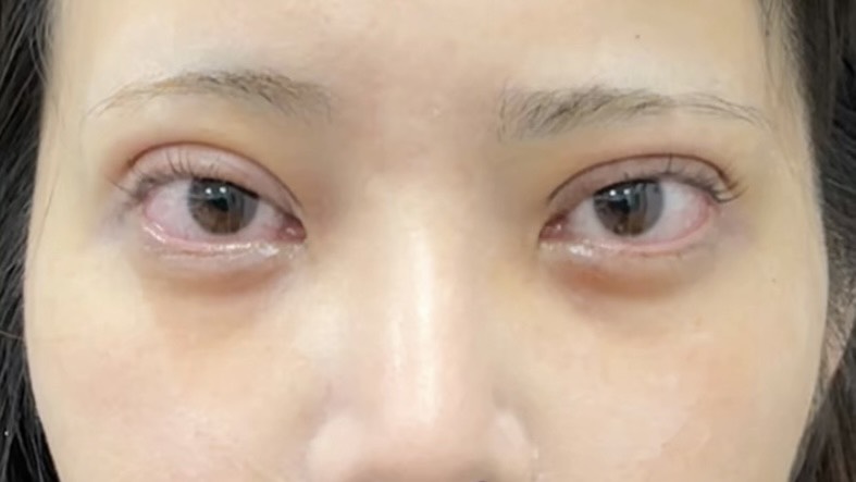 術後1日目