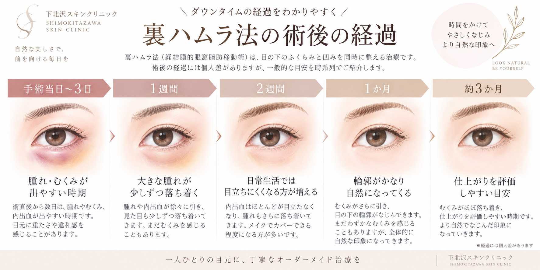 裏ハムラ法の術後経過を当日から約3か月まで示した図