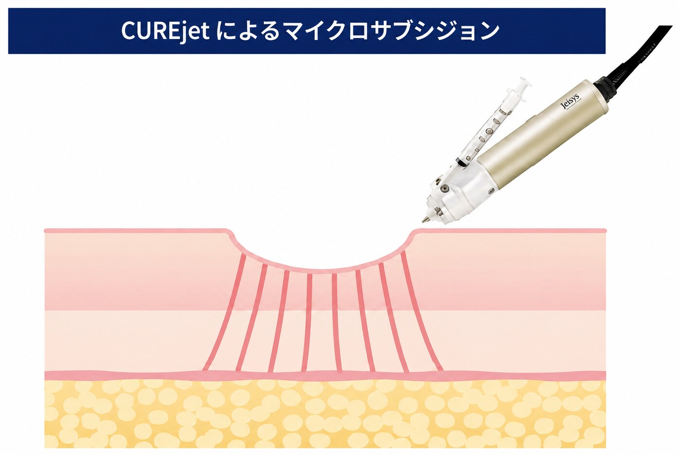 CUREjetによるマイクロサブシジョン