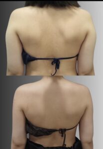 超音波脂肪吸引（二の腕・肩・付け根）の症例写真