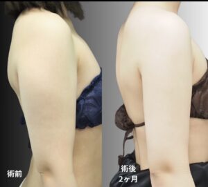 超音波脂肪吸引（二の腕・肩・付け根）の症例写真
