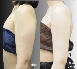 超音波脂肪吸引（二の腕・肩・付け根）の症例写真