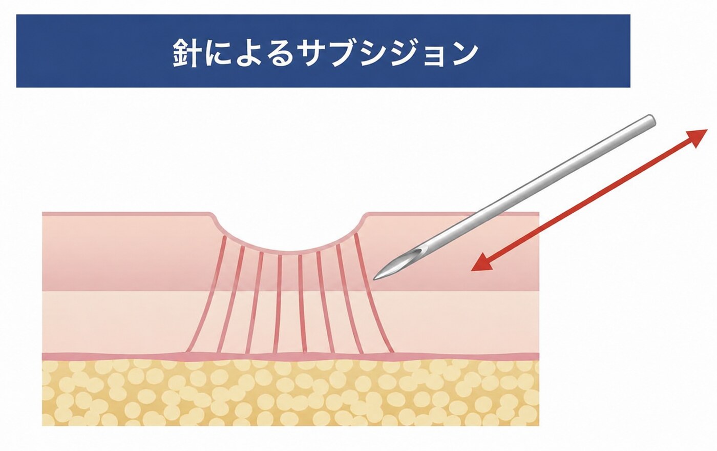 針によるサブシジョン