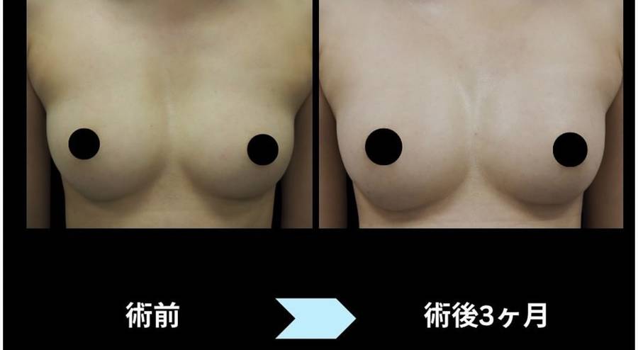脂肪豊胸の術前と術後3ヶ月の比較写真