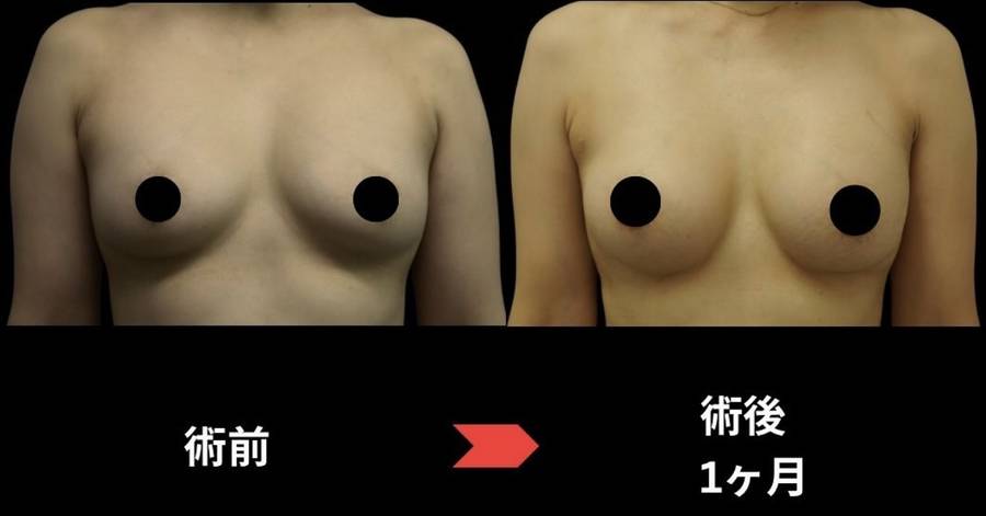 Motivaシリコン豊胸210ccの術前と術後1ヶ月の比較写真