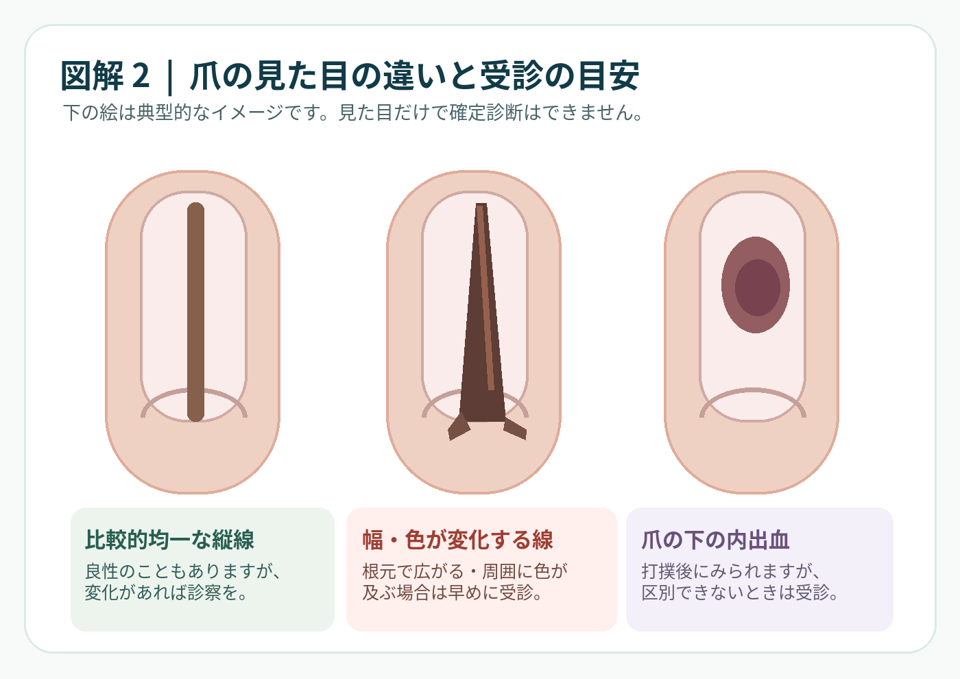均一な縦線、幅や色が変化する縦線、内出血による変色を比較したイラスト