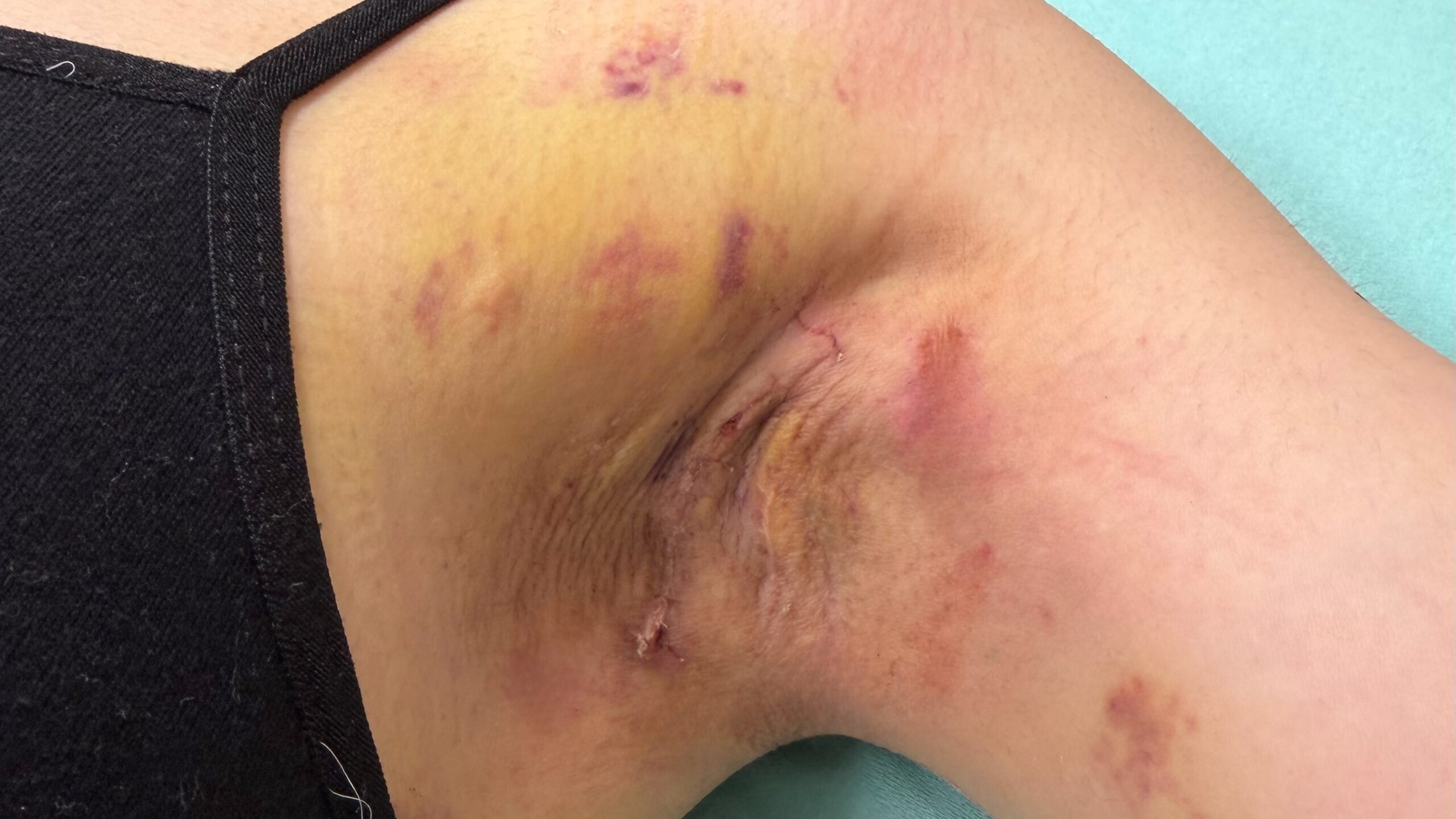 ワキガ皮弁法再手術症例 写真6