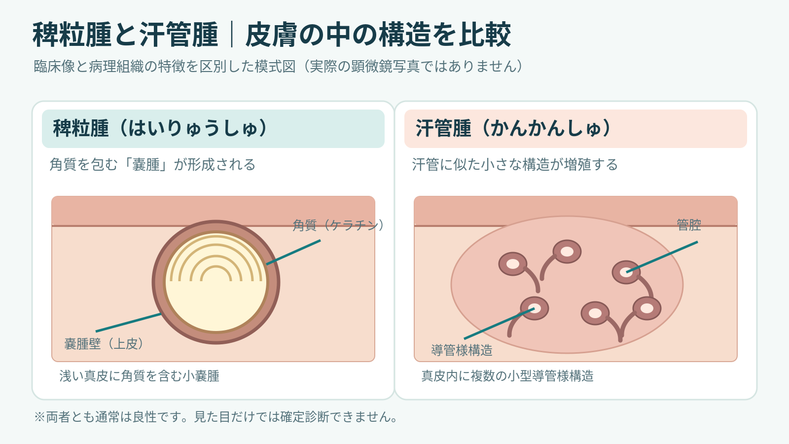 稗粒腫と汗管腫の病理構造比較（医学模式図）