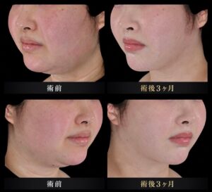 顔脂肪吸引+糸リフトの症例写真