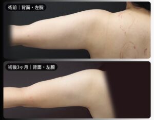 脂肪吸引（二の腕・肩・付け根・副乳）の症例写真
