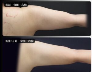 脂肪吸引（二の腕・肩・付け根・副乳）の症例写真
