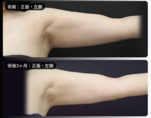 脂肪吸引（二の腕・肩・付け根・副乳）の症例写真