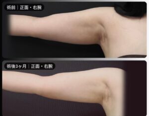 脂肪吸引（二の腕・肩・付け根・副乳）の症例写真