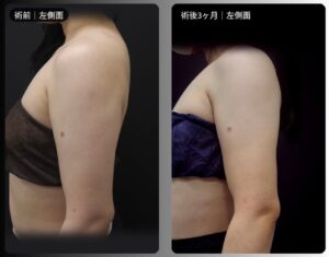 脂肪吸引（二の腕・肩・付け根・副乳）の症例写真