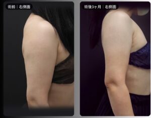 脂肪吸引（二の腕・肩・付け根・副乳）の症例写真