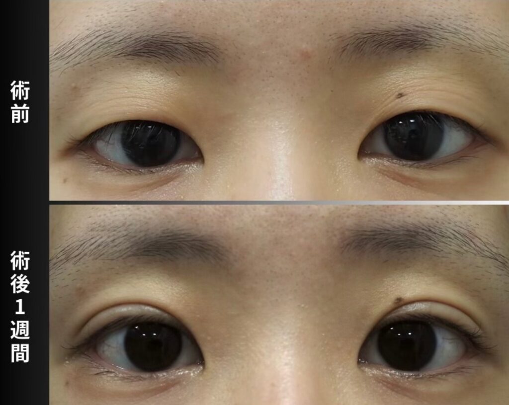 埋没法 挙筋4点留め 開眼時 術前・術後1週間