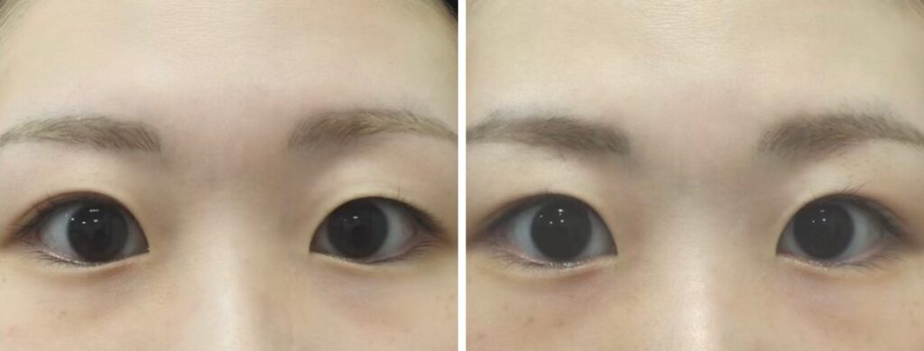 埋没法 挙筋4点留め 開眼時 術前・術後1ヶ月