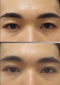 眉下切開＋二重埋没法の症例写真