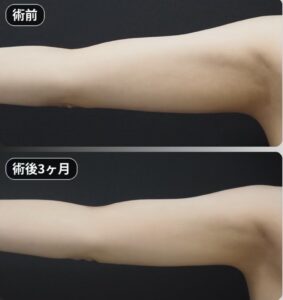 脂肪吸引（二の腕・肩・付け根）