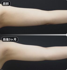 脂肪吸引（二の腕・肩・付け根）