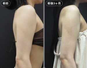 脂肪吸引（二の腕・肩・付け根）