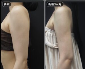 脂肪吸引（二の腕・肩・付け根）